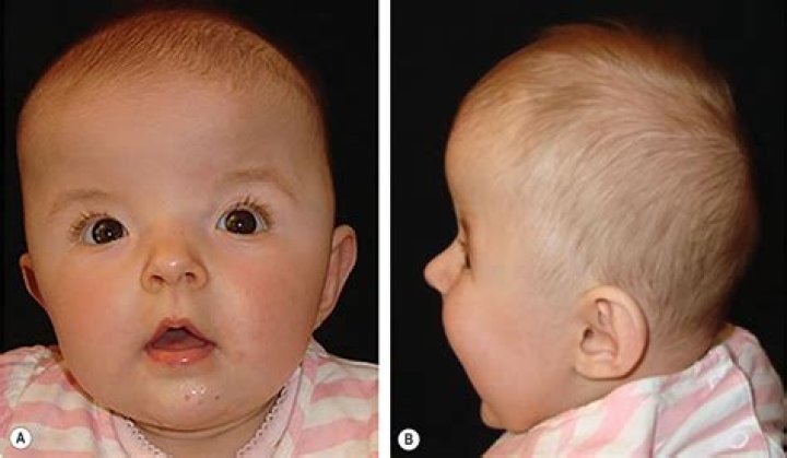 Is craniosynostosis covered by insurance?