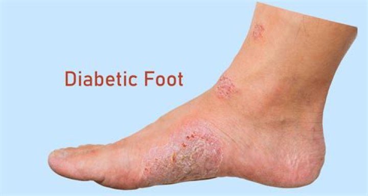 Is diabetic foot pain constant?