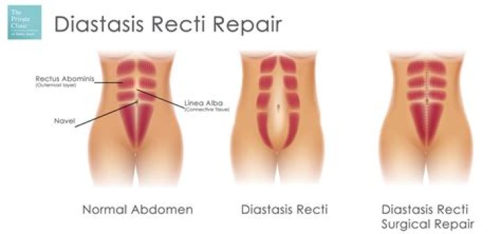 Is diastasis recti surgery worth it?