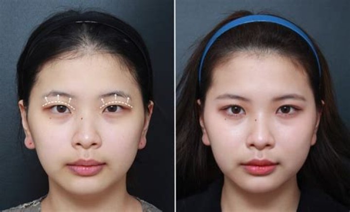 Is dimple surgery popular in Korea?