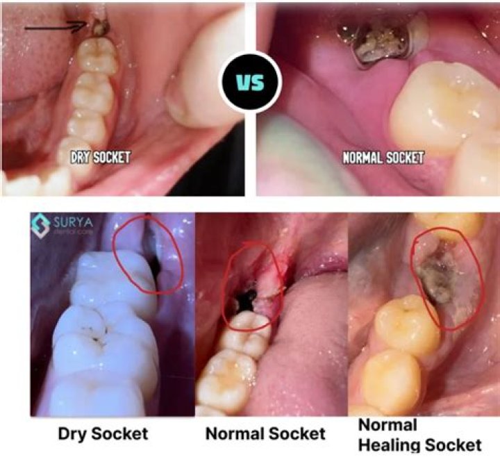 Is dry socket more common in upper or lower teeth?