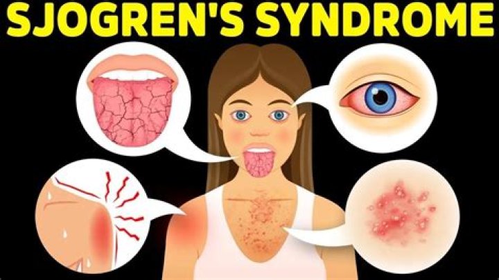 Is eczema a symptom of Sjogren's?