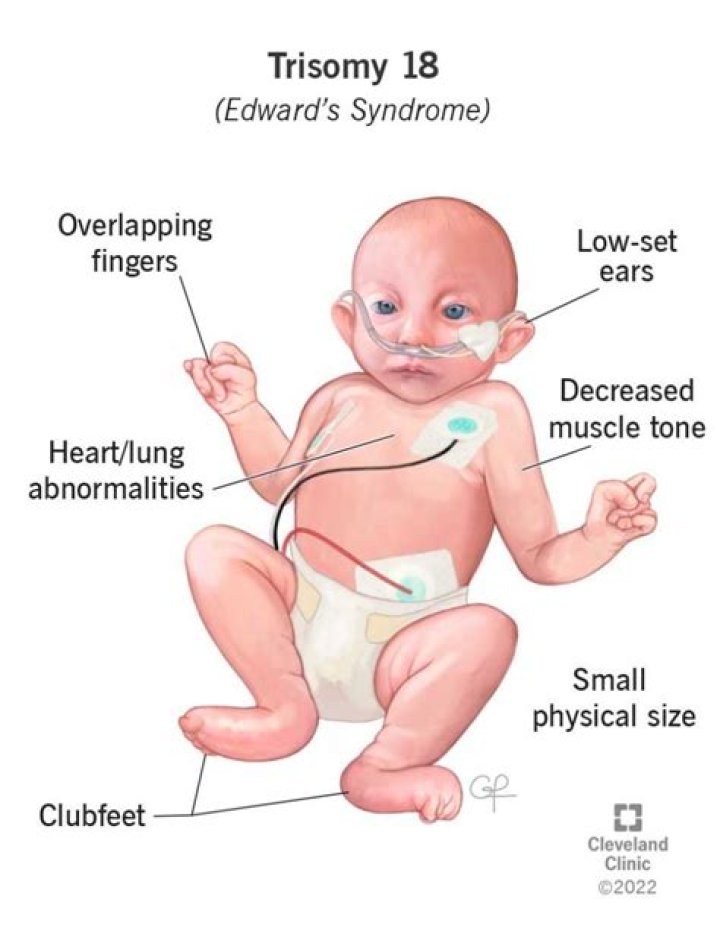 Is Edwards Syndrome genetic?