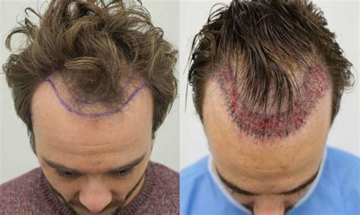 Is hair transplant permanent?