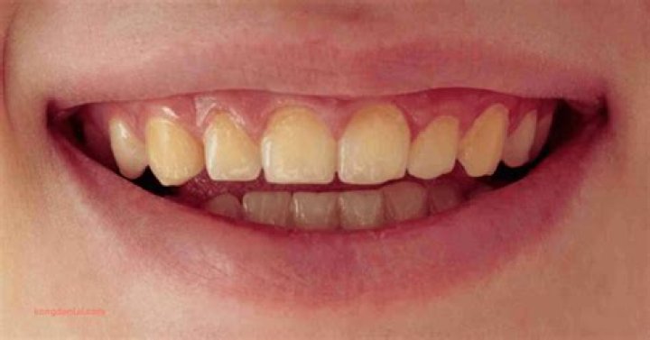 Is having yellow teeth unattractive?