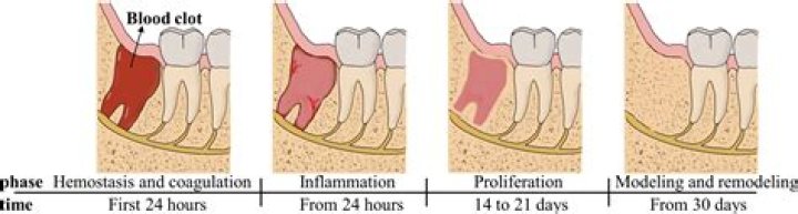 Is it normal to still have pain 2 weeks after tooth extraction?