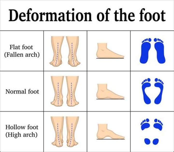Is it possible to fix flat feet?