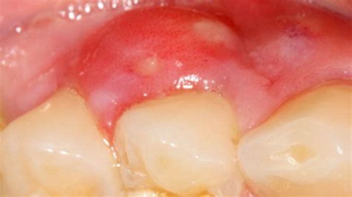 Is Listerine good for a gum abscess?