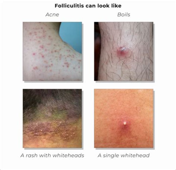 Is my folliculitis fungal or bacterial?
