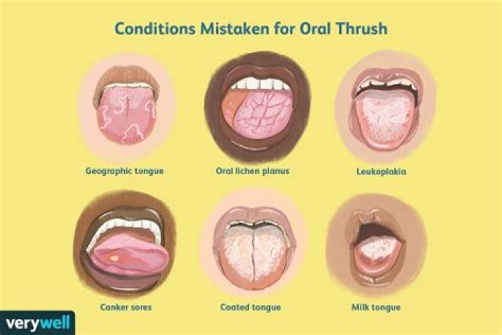 Is oral thrush contagious?