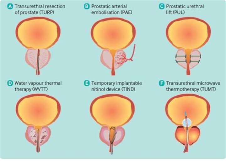 Is prostatectomy better than radiation?