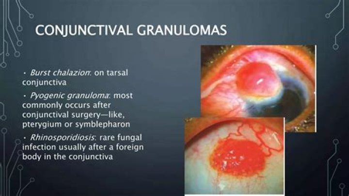 Is pyogenic granuloma rare?