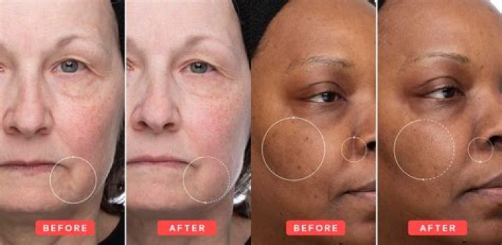 Is Retinol A good for wrinkles?