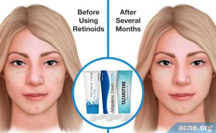 Is Retinol Good for forehead wrinkles?