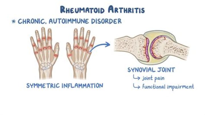 Is rheumatoid arthritis preventable?