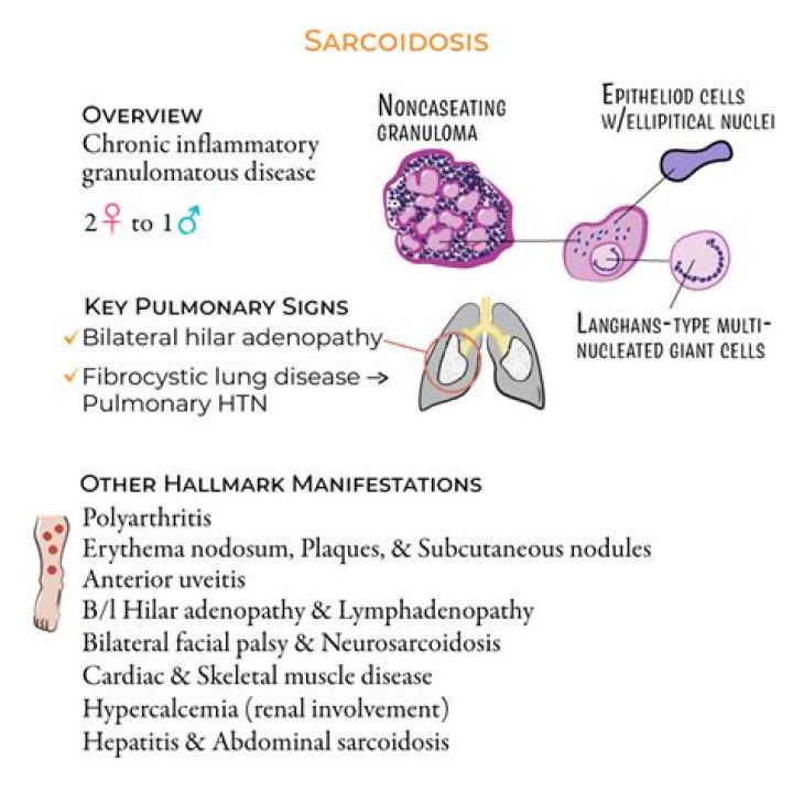 Is sarcoidosis a form of lupus?