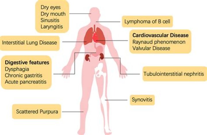 Is sjogrens a form of lupus?