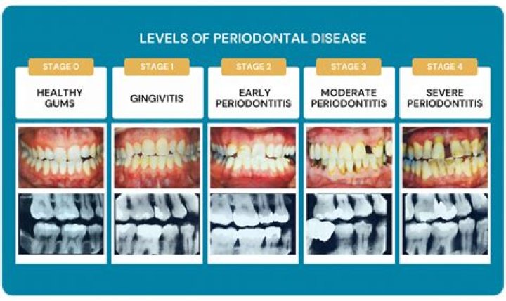 Is Stage 2 periodontal reversible?