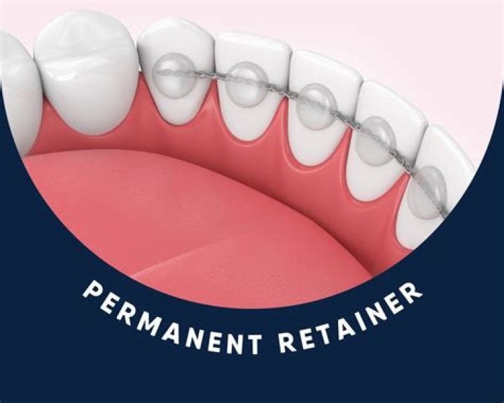 Is the clear or metal retainer better?