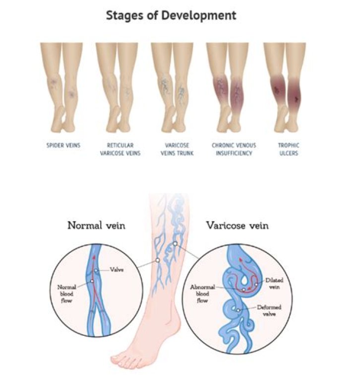 Is venous insufficiency a serious condition?