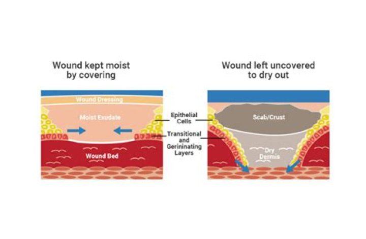 Should a wound stay moist or dry?