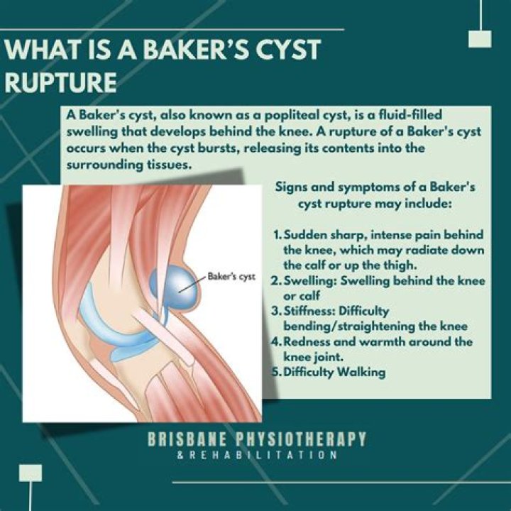 Should I be worried if a cyst ruptures?