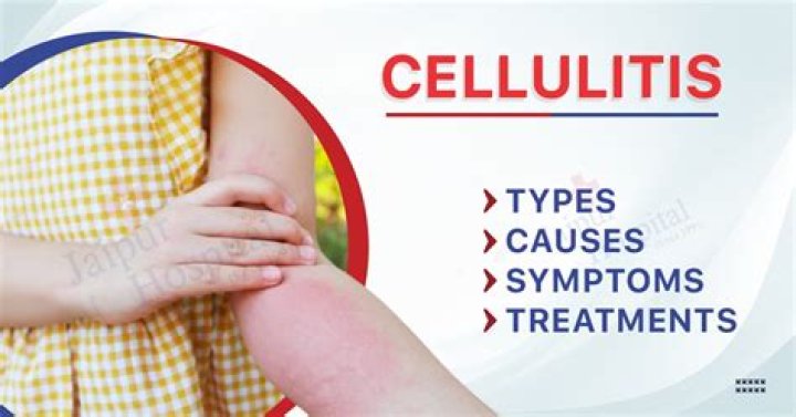 Should I ice cellulitis?