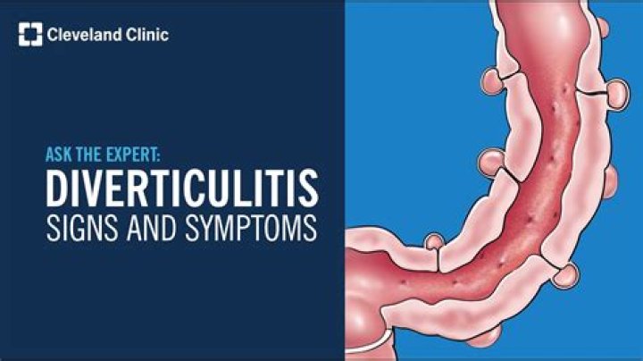 Should I rest or exercise with diverticulitis?