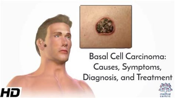 Should I worry about basal cell carcinoma?