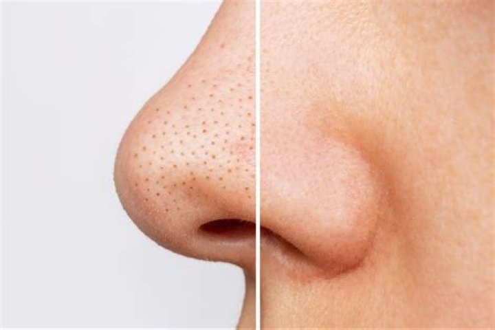 Should you squeeze blackheads on nose?