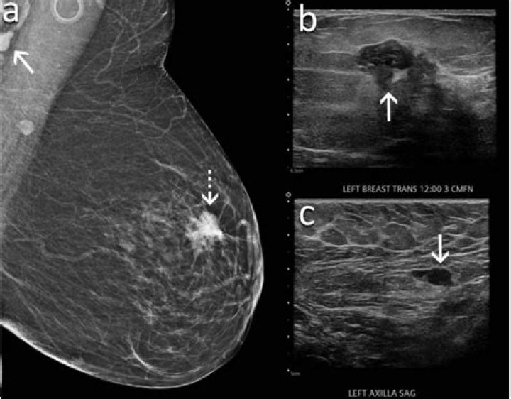 What a breast bud looks like?