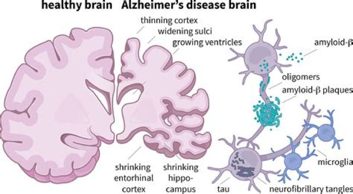 What are the 9 Common Drugs Linked to Alzheimer's?