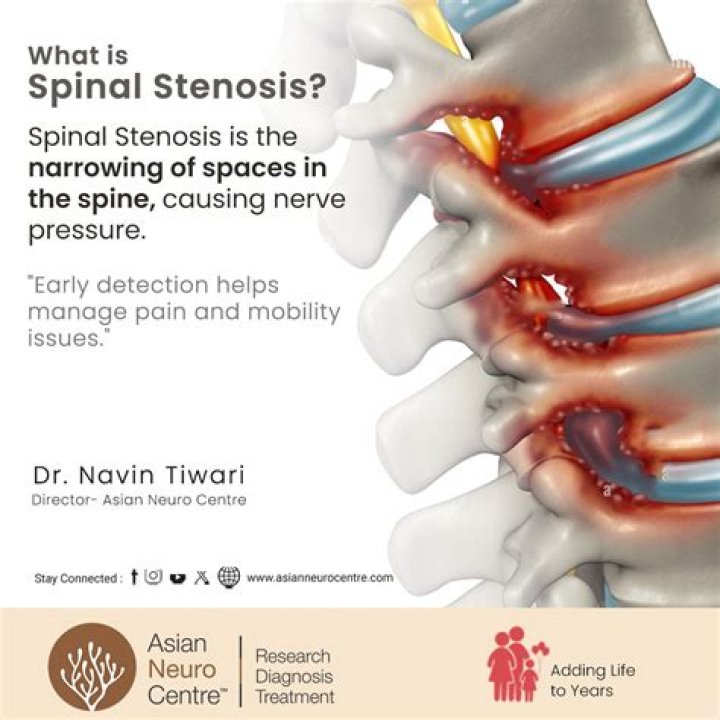 What are the advanced symptoms of spinal stenosis?
