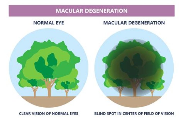 What are the early warning signs of macular degeneration?