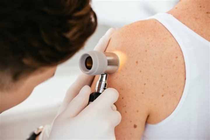 What are the early warning signs of melanoma?