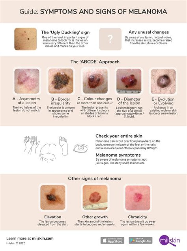 What are the signs that melanoma has spread?