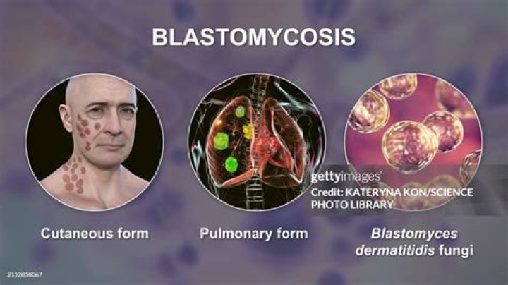 What are the symptoms of blastomycosis?