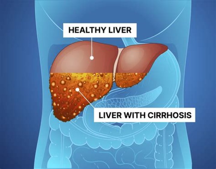 What are the symptoms of stage 4 cirrhosis of the liver?