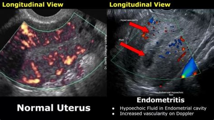 What causes an inflamed uterus?