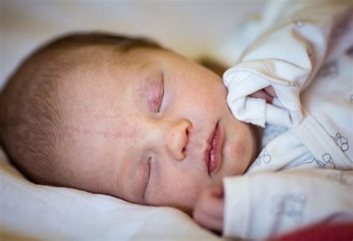 What causes angel kisses on babies?