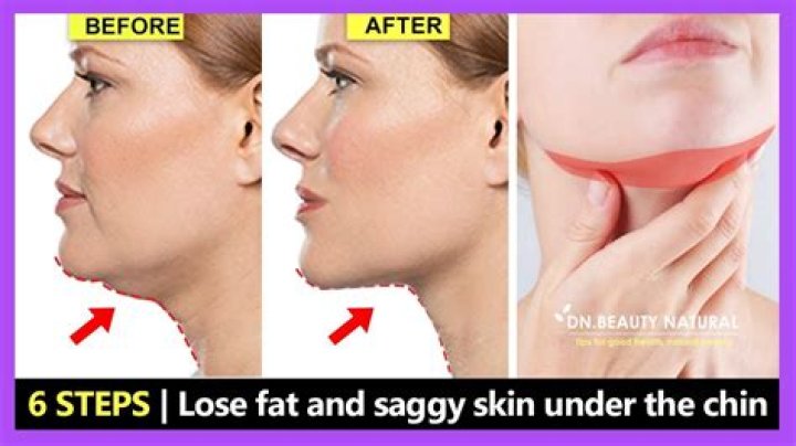 What causes fat under chin?