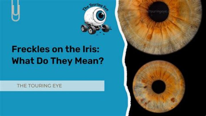 What causes iris freckles?