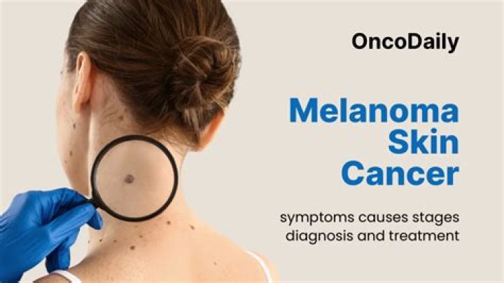What causes melanoma to spread?