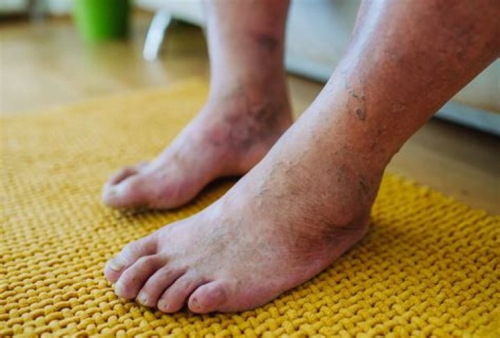 What causes nerve damage in feet?