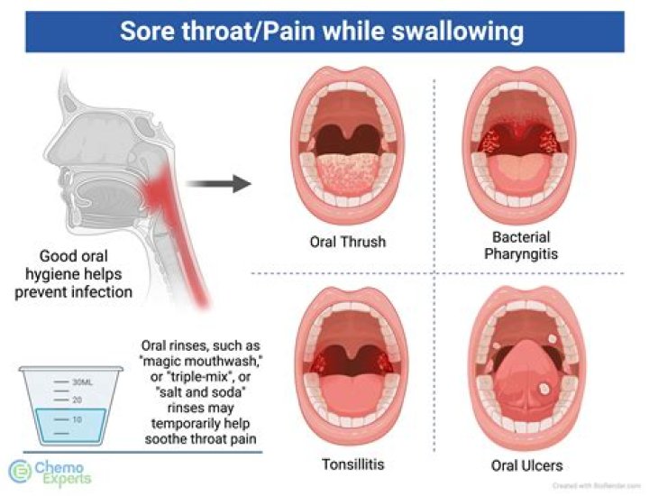 What causes smelly balls in throat?