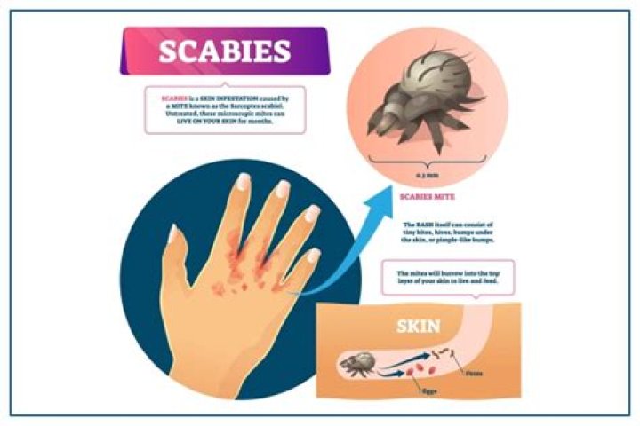 What chemicals can kill scabies?