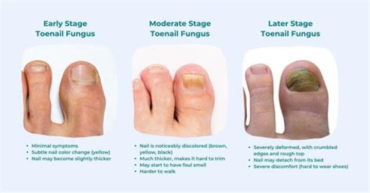 What color does a nail turn on the final stage of a bacterial infection?