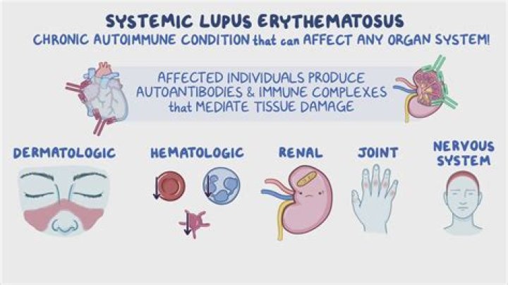 What condition is similar to lupus?