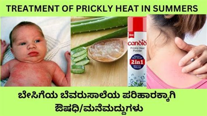 What cream is best for heat rash?