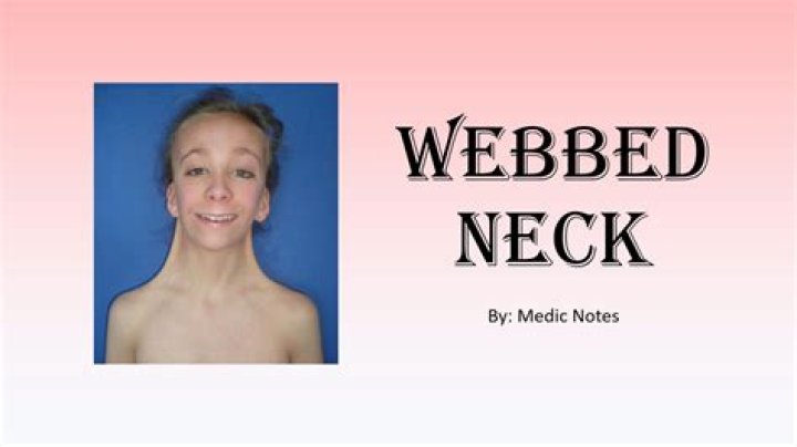 What disorder causes webbed skin in the neck?
